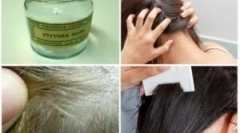 Síra a ortuťová masť z vši a hnus